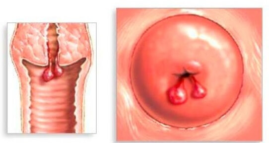 Polyp cổ tử cung 